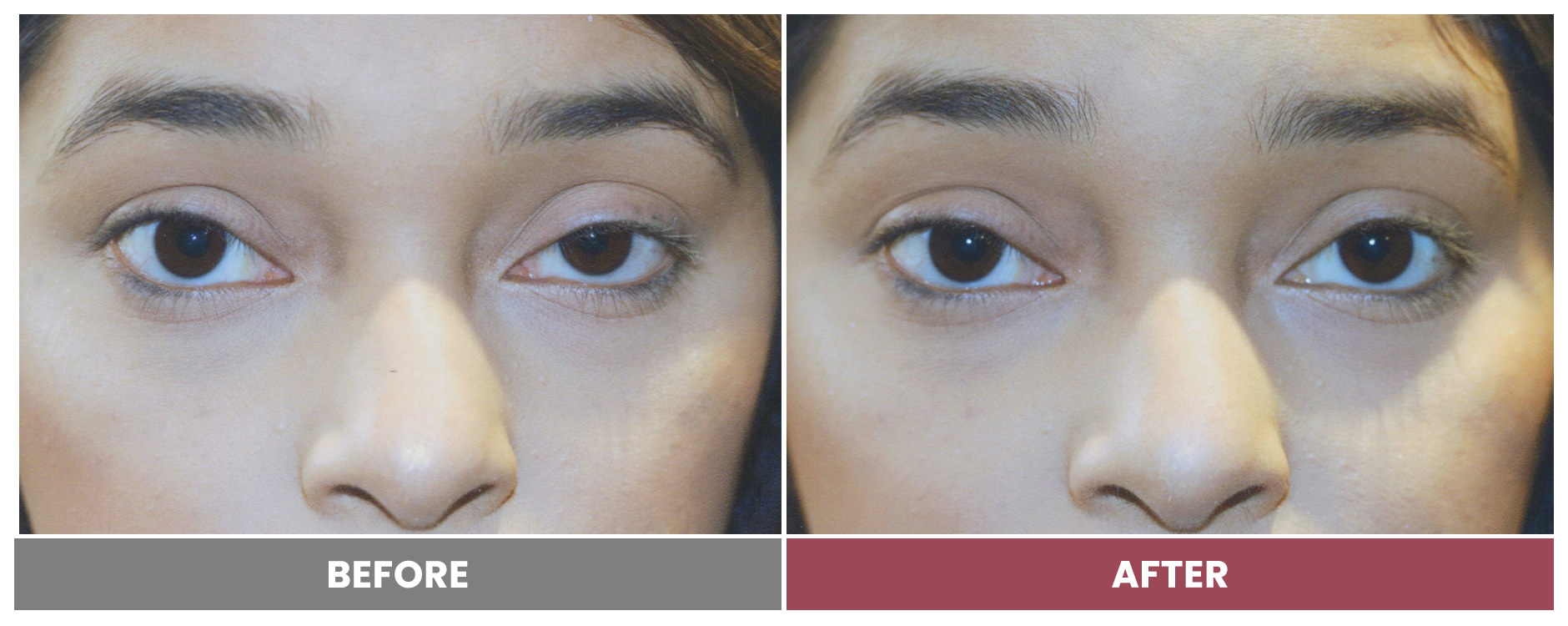 PTOSIS REPAIR - Case 42